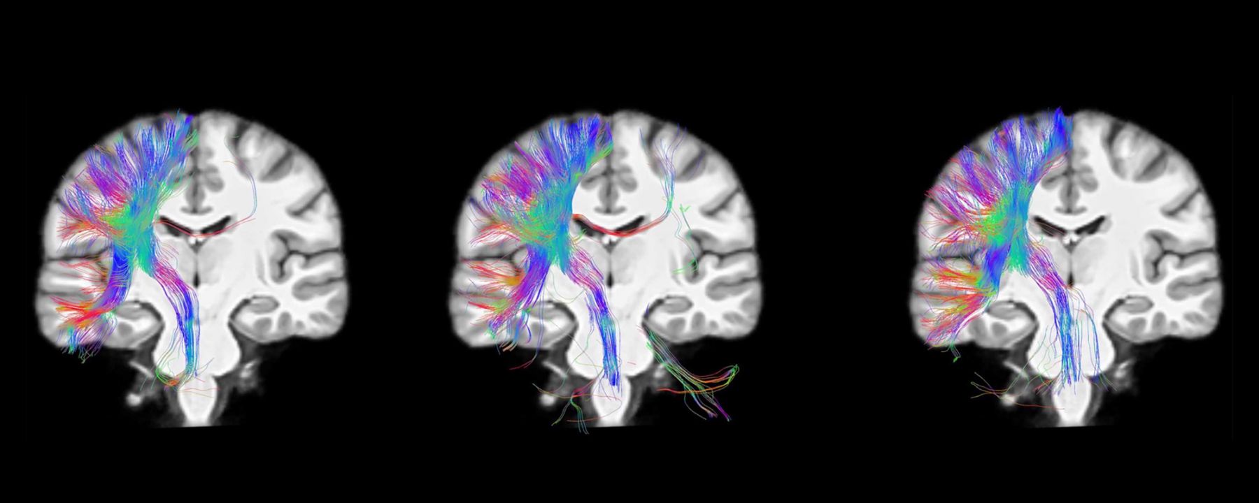 MRI diffusion imaging demonstrating individual variation of primary motor cortex connectivity.